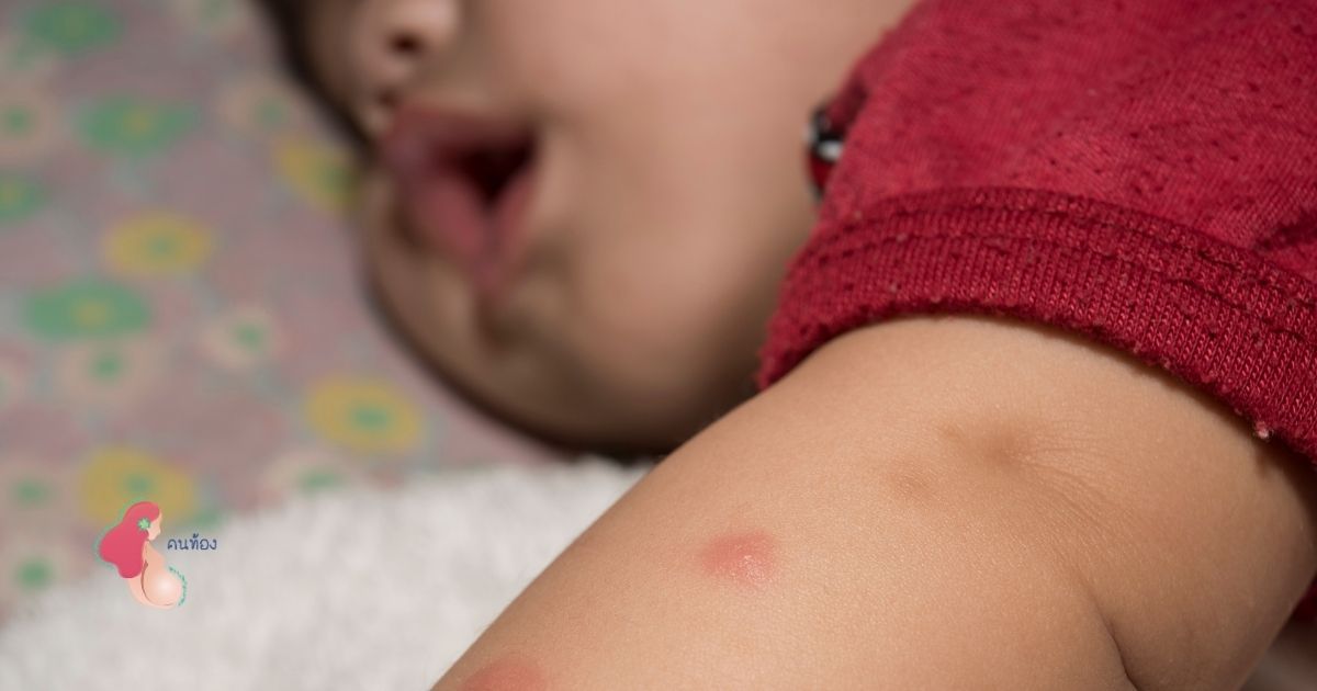 ไข้เลือดออกในเด็ก โรคอันตรายจากยุง ที่อาจทำลูกเสียชีวิตได้