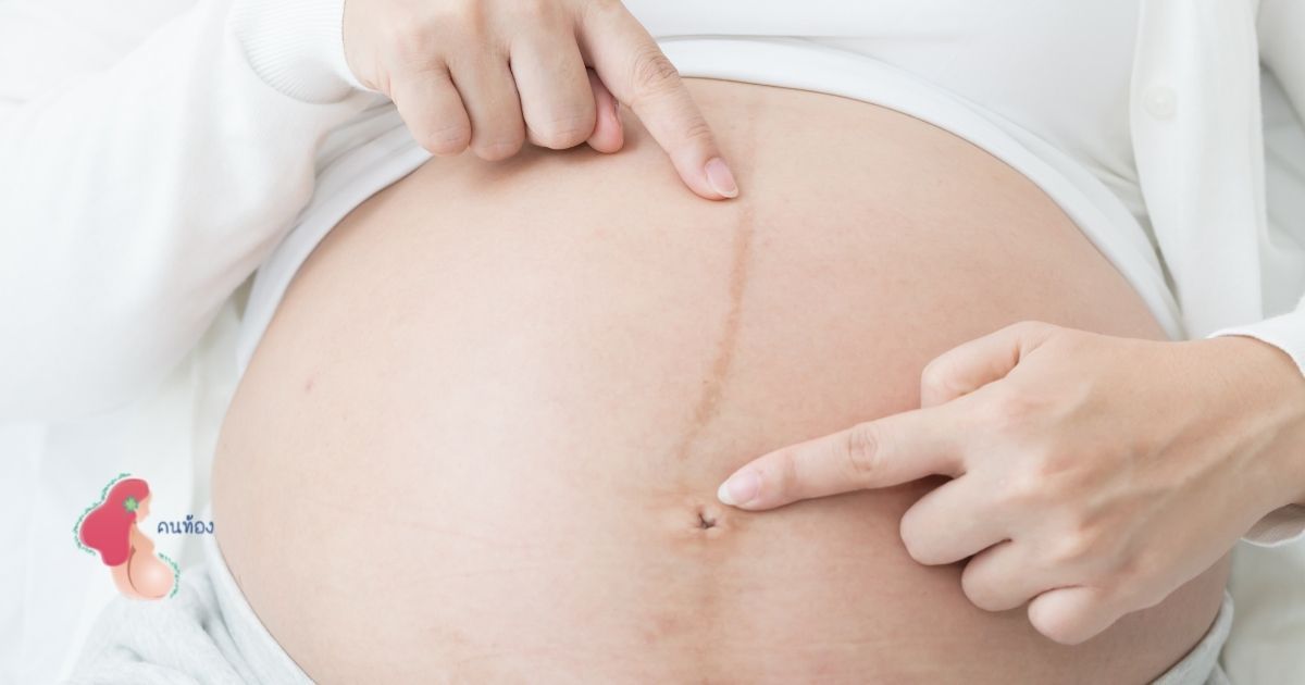 เคยสงสัยไหม เส้นสีดำกลางท้อง ของแม่ตั้งครรภ์ คืออะไร?