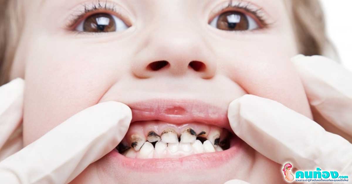 ปัญหาเรื่องฟันในเด็ก Q&A : ไขปัญหาเรื่อง ฟัน สำหรับลูกน้อย