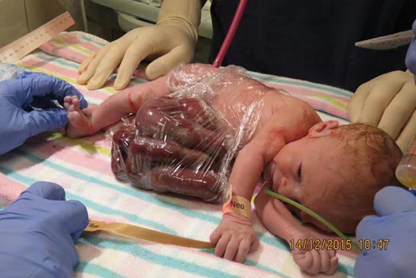 ทารกเกิดมาท้องโหว่ ไส้ไหล ต้องใช้ฟิล์มใสห่อ เพื่อช่วยชีวิต
