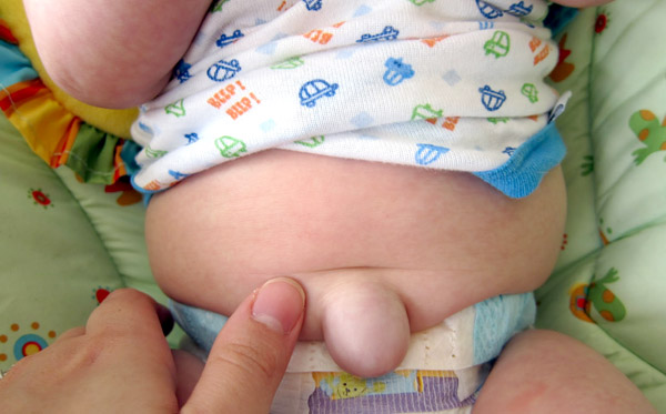 ทารกสะดือโป่ง หรือสะดือจุ่น เกิดจากอะไร อันตรายหรือไม่